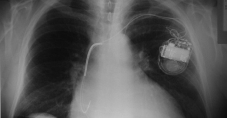 2. Implantes metálicos.