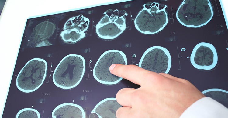 Ataque de epilepsia (iStock)