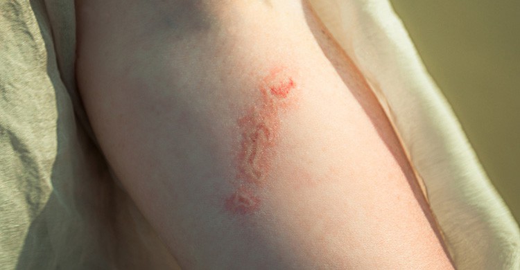 Lesión provocada por la picadura de una medusa