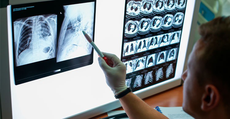 1. Tuberculosis